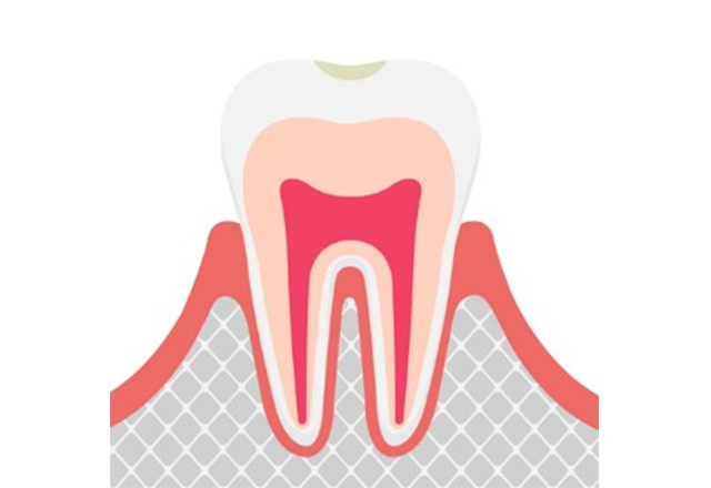 虫歯の進行段階と治療法