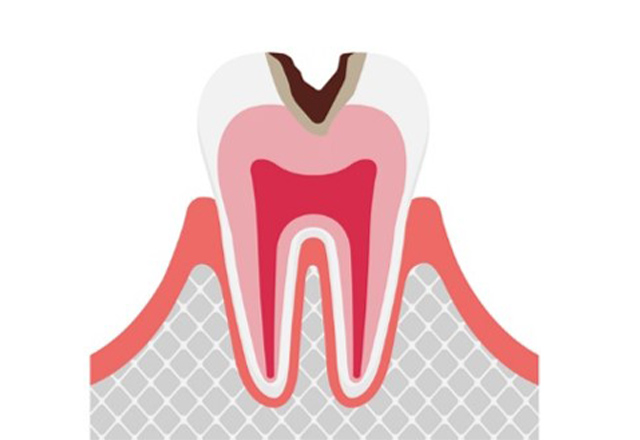 虫歯の進行段階と治療法 C2