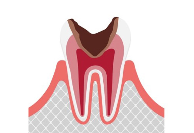 虫歯の進行段階と治療法 C3