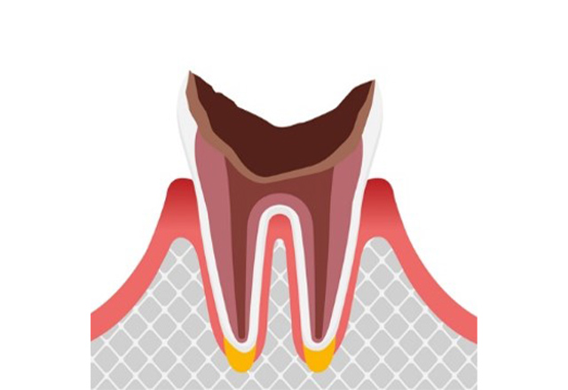 虫歯の進行段階と治療法 C4